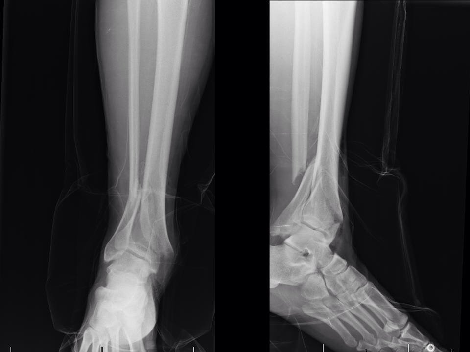 ojedathies's tweet photo. V37a fractura pilón tibial abierta Gustilo II. Fijación int vía anterolat MIPO #FOAMed @traumarioja @gabrielzubim https://t.co/C9i4FYgh3g