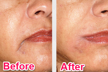 LAVitiligo's tweet photo. Before and After Cosmetic Fillers, Call: (323) 426-6311
#skin #skincare #dermatologist #cosmeticfillers https://t.co/CeZ23XKXIk