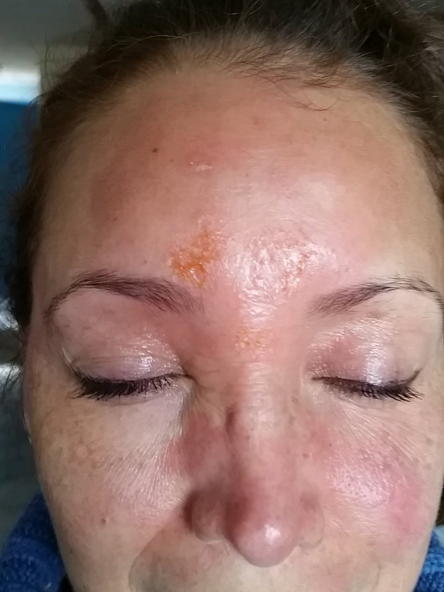 aproa's tweet photo. @javierderma buenas dr. Me podria ayudar me salio esto en la cara y siento mucha picazon y esta muy inflamado https://t.co/Jh8lU9XBQh