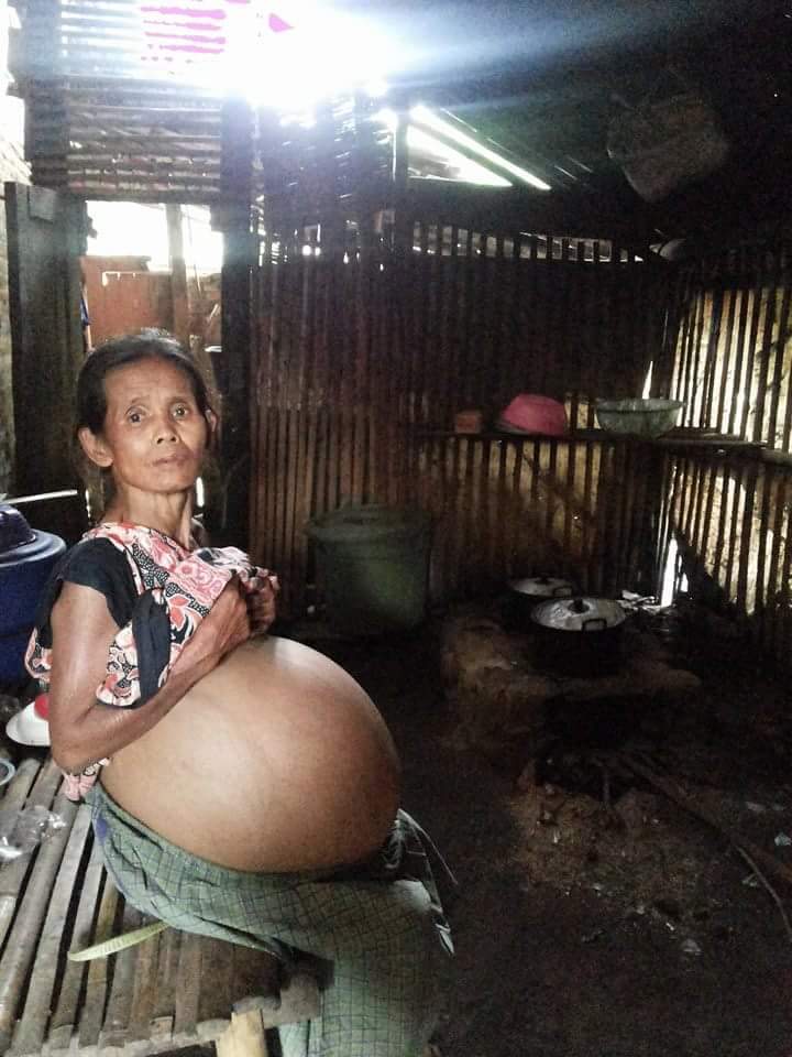demeter1992's tweet photo. #savejumaiyah warga sumberjambe Rt.12 Rw.03 kecamatan.poncokusumo kabupaten.malang. penderita tumor diperutnya. https://t.co/nCiuBSpMPd