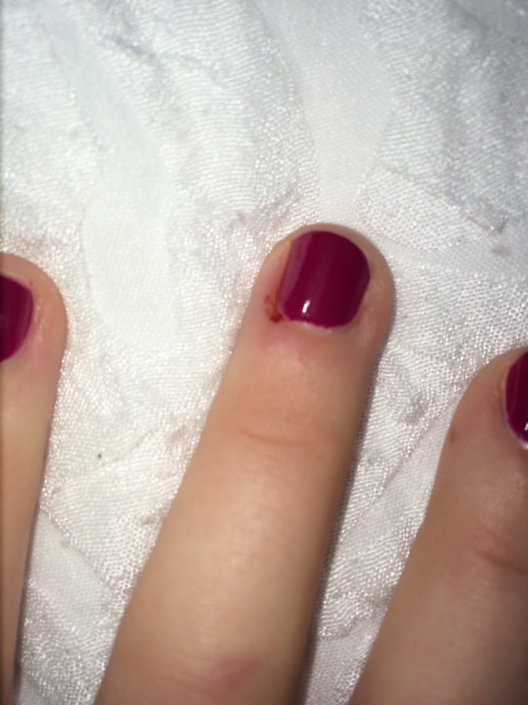 GraphicQuestion] I bite my nails so short and skin around to the point it  hurts and I occasionally bleed a bit. Should I see a specialist to help  stop it or will