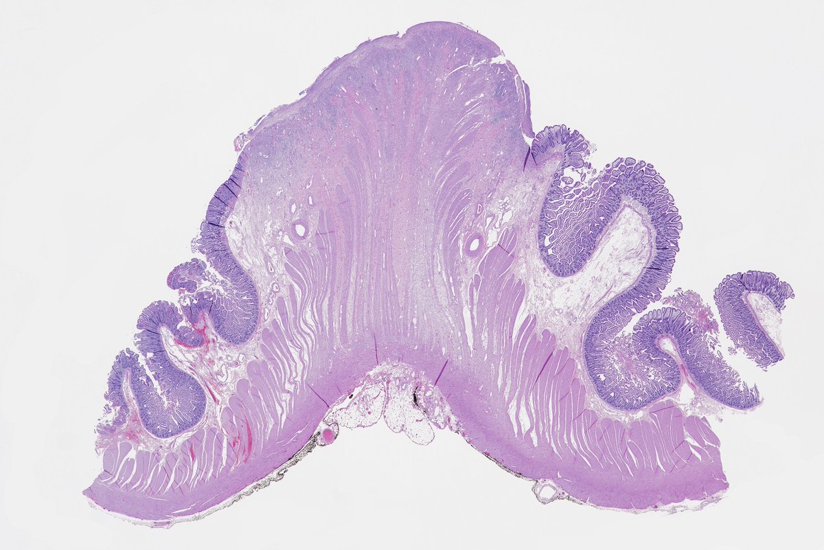 Hopkins_GI_Path's tweet image. NIce 1x view of diaphragm disease in the small intestine. #pathologists