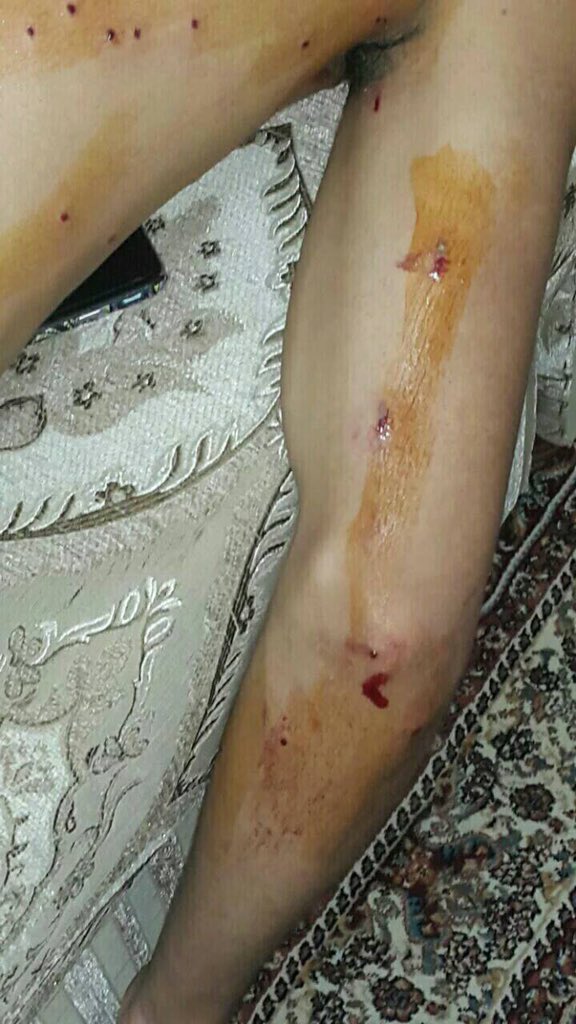 SALAM_DHR's tweet photo. Use of shotgun heavily today against peaceful demonstrators in several areas in #Bahrain https://t.co/8PXGqV6qik