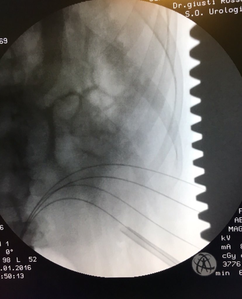 Smooth beginning after Xmas break 😁 4 accesses supine #PCNL 4 staghorn cystine stone. I already need holiday again 😂