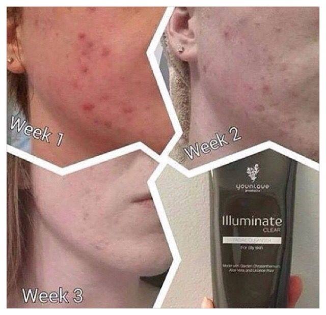cosmetics_zoe's tweet photo. Our facial cleanser is so amazing ☺☺ its not just for woman!!💁🏼 just check these results NOW MASSIVE RESULTS IN DAYS https://t.co/aYOTxiCKQQ