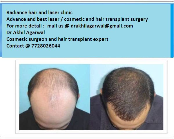 apex_hospitals's tweet photo. #Hairtransplant USP is #folliclegraftingtechnique . 
We use #latestmachine  #besthospitalsetting #lessinfection https://t.co/JtGEL0IbOF