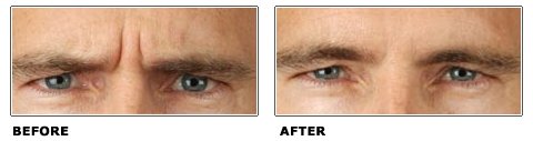TheSkinyOnSkin's tweet photo. Wrinkles be gone! #wrinkles #finelines #botox #malebotox https://t.co/lYfMXkxJb7 https://t.co/DXX4FHtv9N