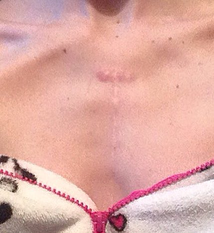 deadlythintea's tweet photo. Are these chest bones? Or are they apart of my scar? #bones #boney #bonepso #eds #edlogic #question #thinner #skinny https://t.co/IukjX68w1I