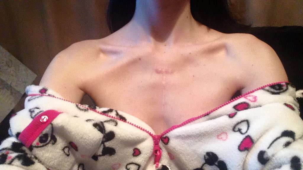 deadlythintea's tweet photo. Are these chest bones? Or are they apart of my scar? #bones #boney #bonepso #eds #edlogic #question #thinner #skinny https://t.co/IukjX68w1I