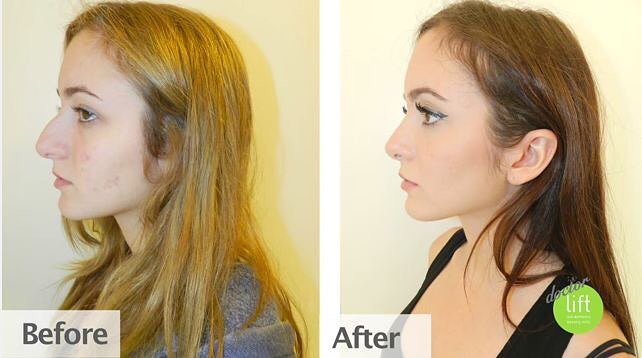 DrGaroKassabian's tweet photo. #hello2016gorgeous #hello2016 #lookinggoodfeelsgood #rhinoplasty #freeconsultation #boardc… https://t.co/JAUPuPCAv6 https://t.co/e9a9OvhVfZ