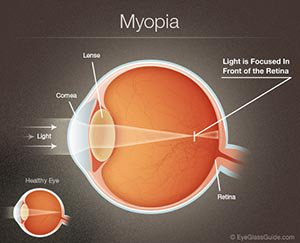 LaserEyeSV's tweet photo. What Causes Nearsightedness? #vision https://t.co/sNvGlIjIDP https://t.co/lbBBrH4oQF