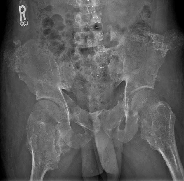 RadiologySigns's tweet photo. Q: What disease is seen here? Any other findings? ANSWER: https://t.co/USIhoL1RxW #FOAMrad #FOAMed https://t.co/WGjLXGDfYs