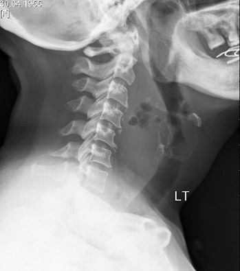 RadiologySigns's tweet image. Q: Diabetic woman w neck pain 4 days after swallowing fish bone Diagnosis? 
ANSWER: goo.gl/gG75HQ #FOAMed