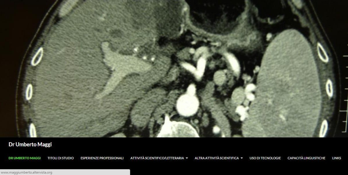 La colecistite acuta alitiasica - acute acalculous chocystitis: maggiumberto.altervista.org/?p=284
#liver, #gallbladder,