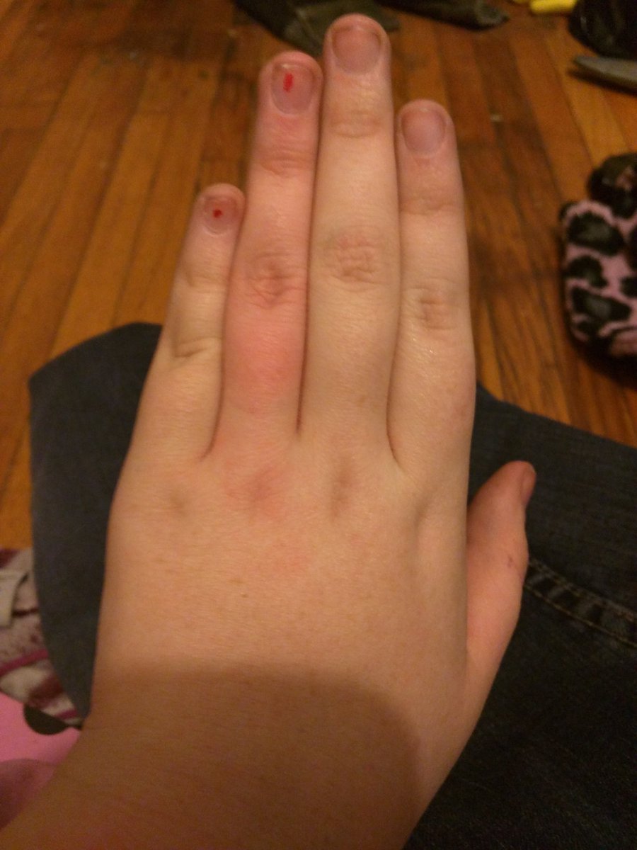 Bethany7464's tweet photo. Omg, I just accidently cut off blood to my finger for a minute, now really hurts. I almost couldn't get the ring off https://t.co/bnfXO9zuDs