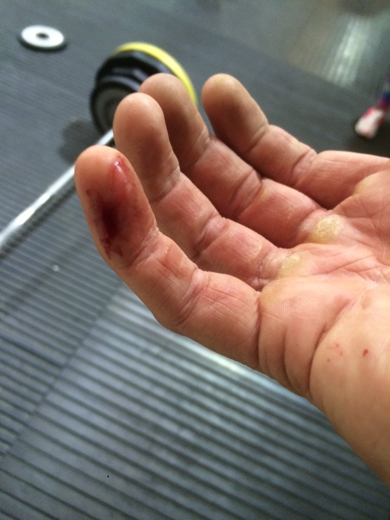 tonycaradas8's tweet image. Slamming weight plates together... And forgetting to move the little pinky!! 😩 #Owchie