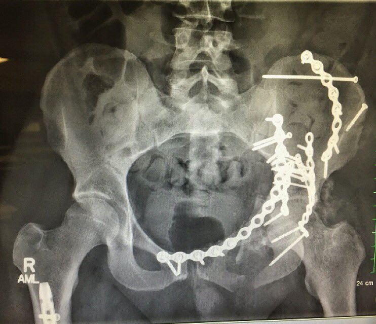zachjayjohnson's tweet photo. #SlashBackSunday to my pelvis and right leg. Just a touch of metal in me 👌🏼 https://t.co/ocD8mZgok4