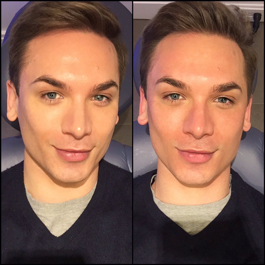 miss fame before hydrafacial instagram extraction