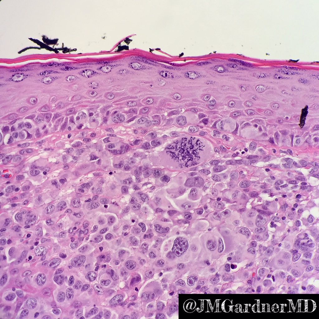 JMGardnerMD's tweet photo. Now THAT is an atypical mitosis! #melanoma #pathology #dermpath https://t.co/3jeXmjgH5d