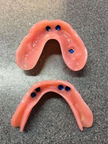 OswestryDentLab's tweet photo. @BioHorizonsUK implant retained F/F dentures with #schottlander #Natura and #HiImpact acrylic https://t.co/IQHxeSXXy6