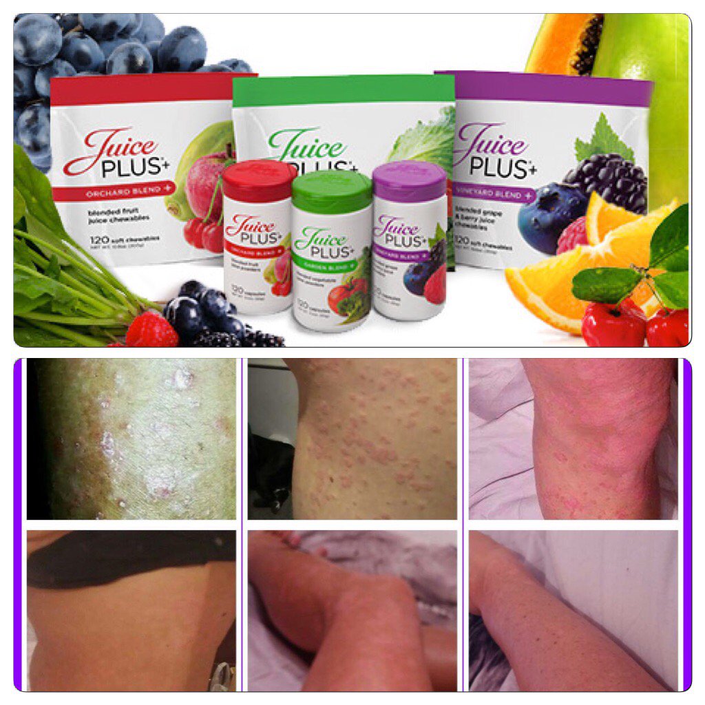 SamChatwood's tweet image. Absolutely amazing psoriasis results from our premium capsules🍒🍎 message me for info!!🙌😊🍅🍉🍏 bit.ly/LiPix-App