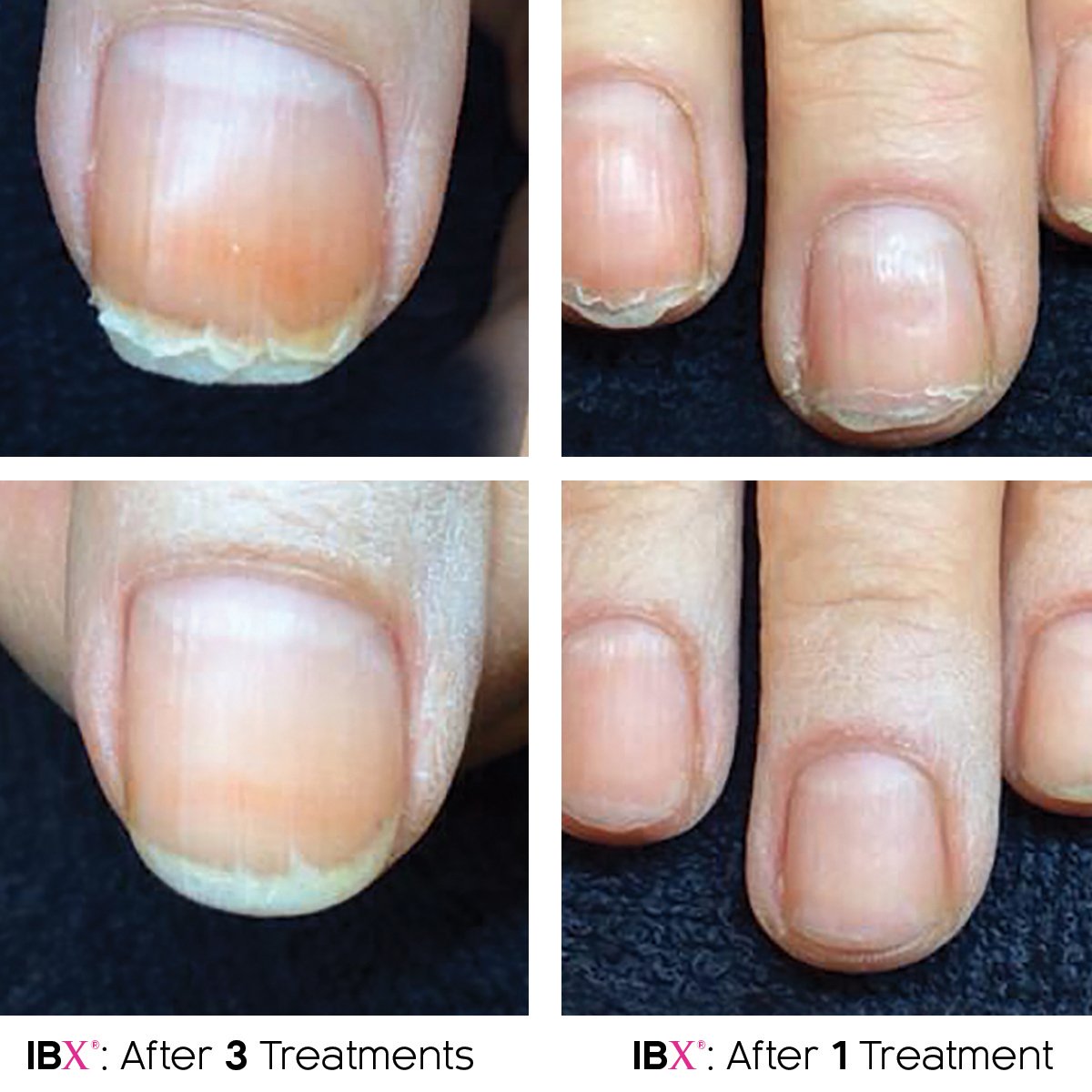 buff.ly/1ONlE6O <<<< for more Before and Afters! #ibx #healthynails