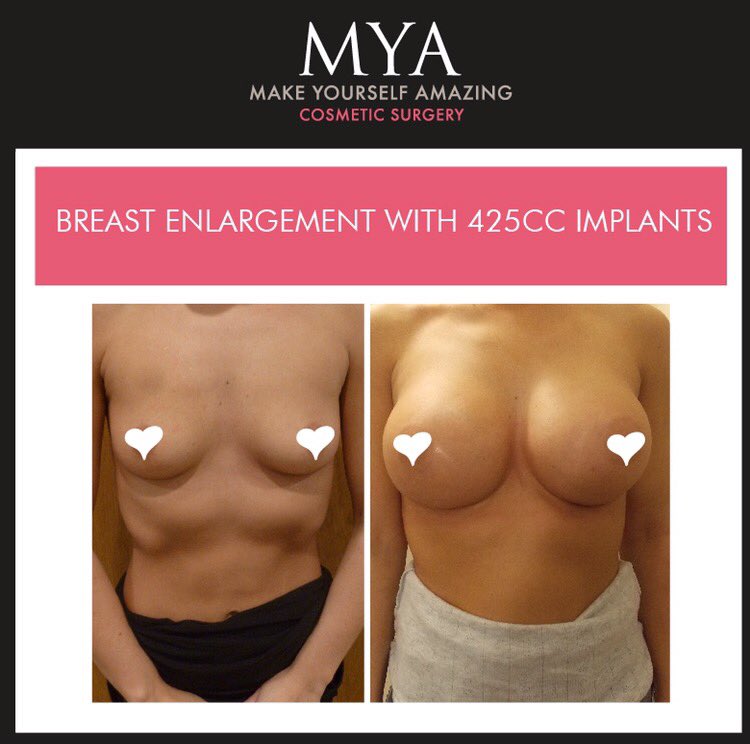 MYA_Tweet's tweet photo. Amazing Breast Enlargement! π 425cc
#MYA #BreastEnlargement #425cc #Implants https://t.co/dYksJBtpFI https://t.co/VFXpnrJkcF