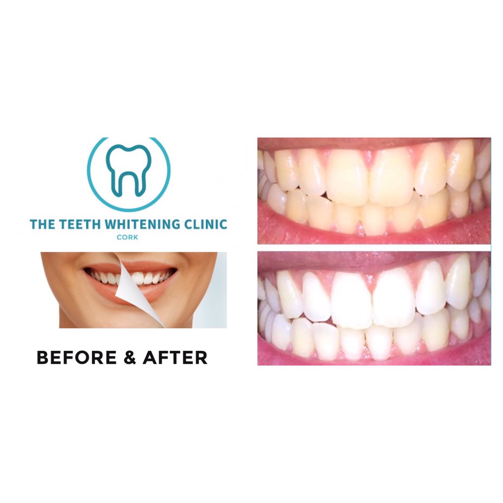 TTWCCork's tweet photo. Our #results can't be beaten for #teethwhiteningcork & #zerosensitivity #guaranteed #cork #teeth https://t.co/ig5csiTrkC