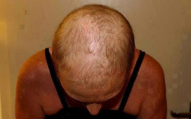 chicfacenbody's tweet photo. Alopecia and female baldness - is it a growing problem? #hairloss #thinninghair #alopeica https://t.co/3bALPIEAkd https://t.co/zBj1nXx27A