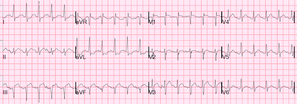 smithECGBlog's tweet photo. This was a very instructive case.  Sudden severe SOB and ST Elevation: #FOAMed https://t.co/34WthuIEuN https://t.co/4VioVQShDN