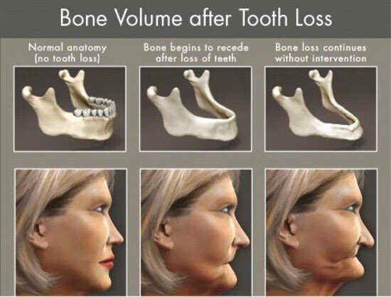RyanMcCallDDS's tweet photo. 🔊📲 317-596-9700
#betterdentures #missingatooth https://t.co/5eVOd7fVLQ