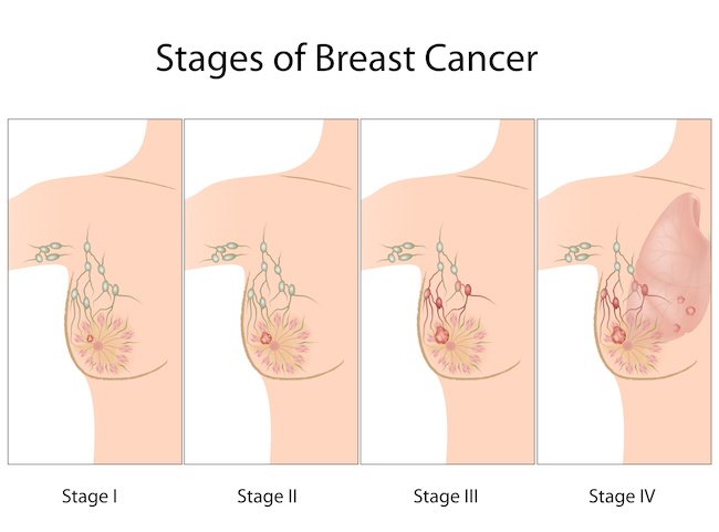Understanding breast cancer wp.me/p4jAs4-p2