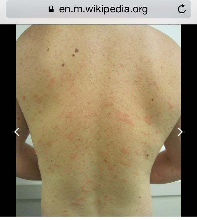 pityriasis rosea christmas tree pattern