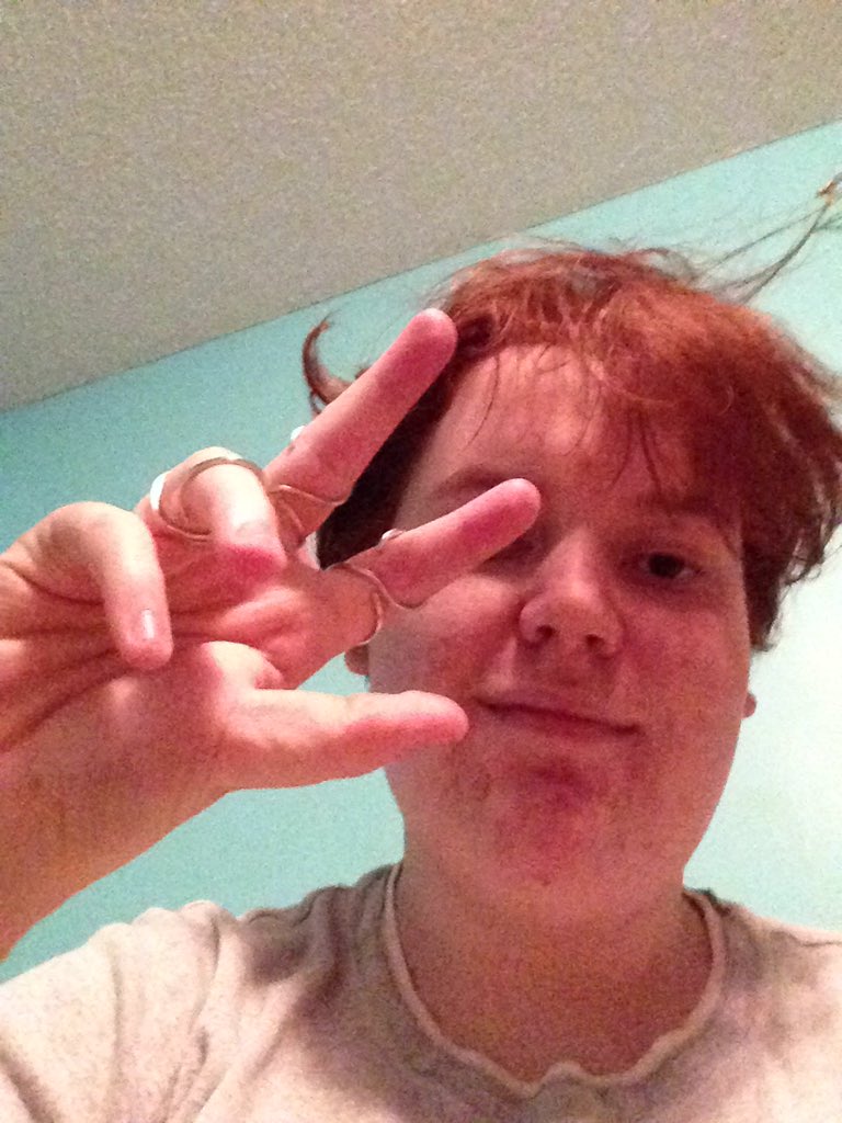 //My hand is fully braced up and i felt showing my face would be fine ^-^//