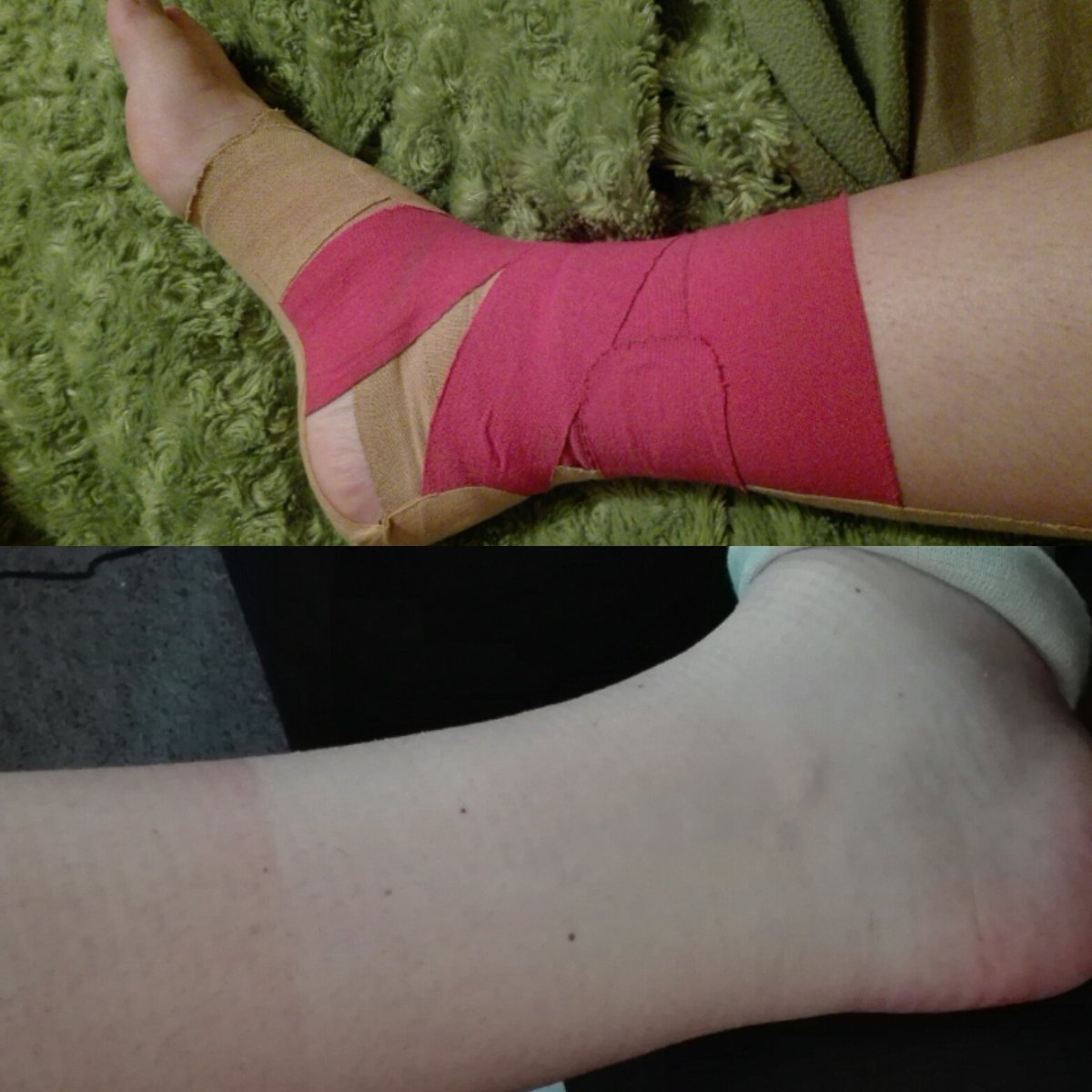 briisawesome19's tweet photo. The results of being injured at #cbee16 in really sunny weather! Gotta love the tanlines! #jamboree #girlguidingnz https://t.co/Y8XhnNoa41