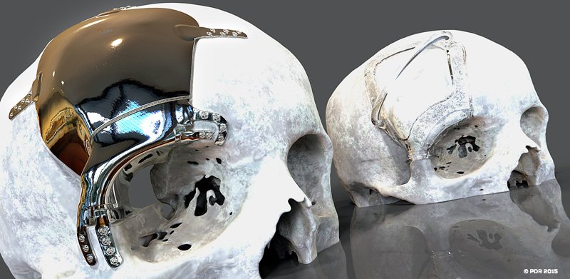 PDR_SPD's tweet image. Our third new paper: sciencedirect.com/science/articl… = cleanliness, surface characteristics&amp;amp;finishing of med #AM materials.