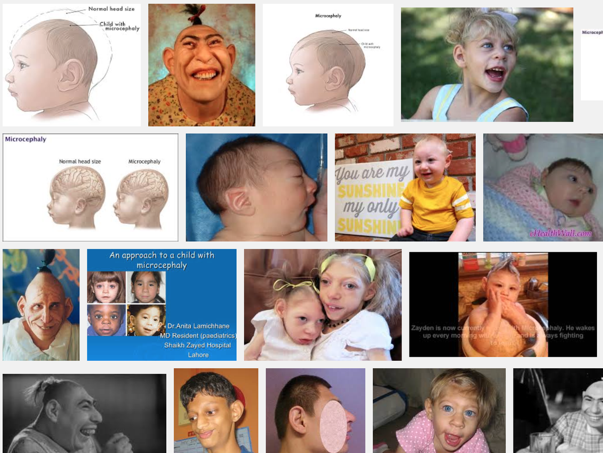 Kawamint Cmk2wl 広島長崎の原爆の後 小頭症 の子どもが誕生した事実があるのに かなり前にnhkでもやっていた 排出された放射能の量がそれより多いはずの福島で そのようなケースが全く報道されないことが恐ろしくて仕方ない