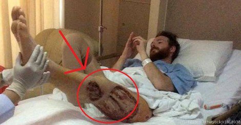 Bug Almost Ate Away Backpacker's Leg While He Was On A Holiday bit.ly/1Pcx8dW