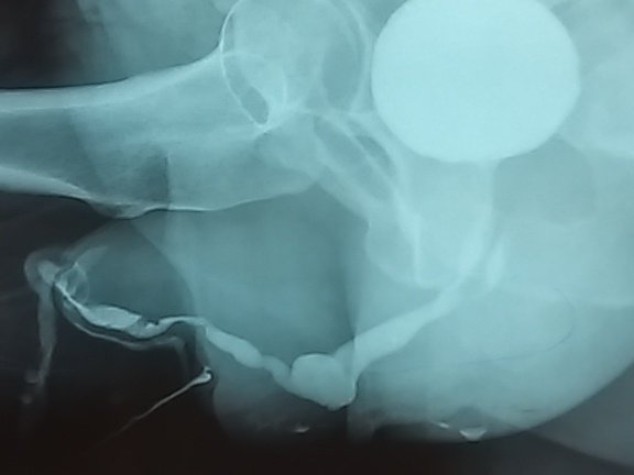 Exemple typique d hypospadias multi opéré, maintenant désespéré.