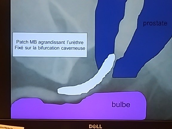 Best site for grafting in membranous urethral stenosis