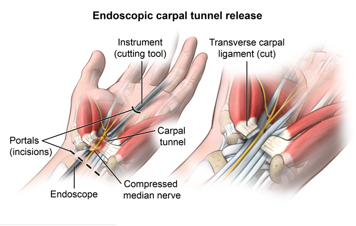 HopkinsMedicine's tweet photo. Carpal tunnel release is one of the most common surgeries performed in the US. https://t.co/QtudjqcSDv https://t.co/Ashq4pqor8