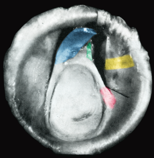 DavidStollerMD's tweet photo. New concept of rotator cable&overtensioning cuff in repair to be discussed #ShoulderWorkshop https://t.co/NKmgreJEct https://t.co/Qbl2UO3kdn