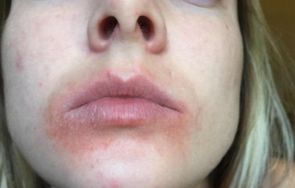 medical_tech_'s tweet photo. This Popular Lip Balm Has Been Called Out for Causing Rashes https://t.co/NgdLcstLFq https://t.co/kQZeUee1H3