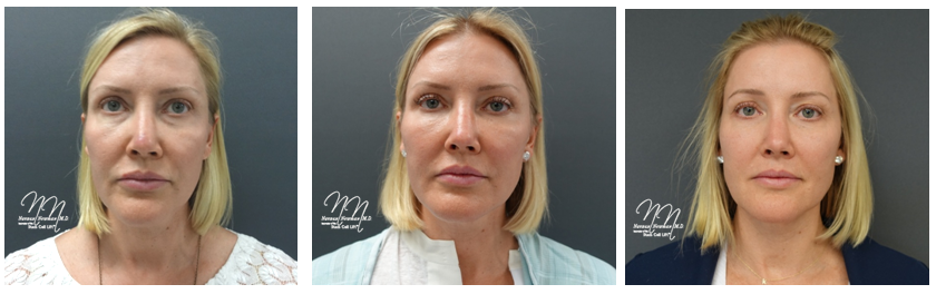 drnathannewman's tweet photo. Before, 1 month, and 3 months after. #stemcelllift #facelift #stemcellfacelift #skintightened https://t.co/D1jdsg0pjf