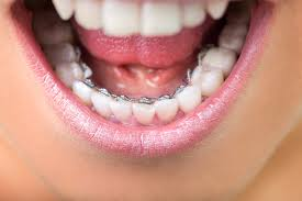Orthodontics is a branch of dentistry which deals with the treatment of irregularities of the teeth.