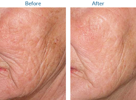 LAVitiligo's tweet photo. Before and After Katalaya Peel #dermatology #skincare #skin #beauty  #vitiligo #katalaya #katalayapeel #facepeel https://t.co/LM1PmPUPFw