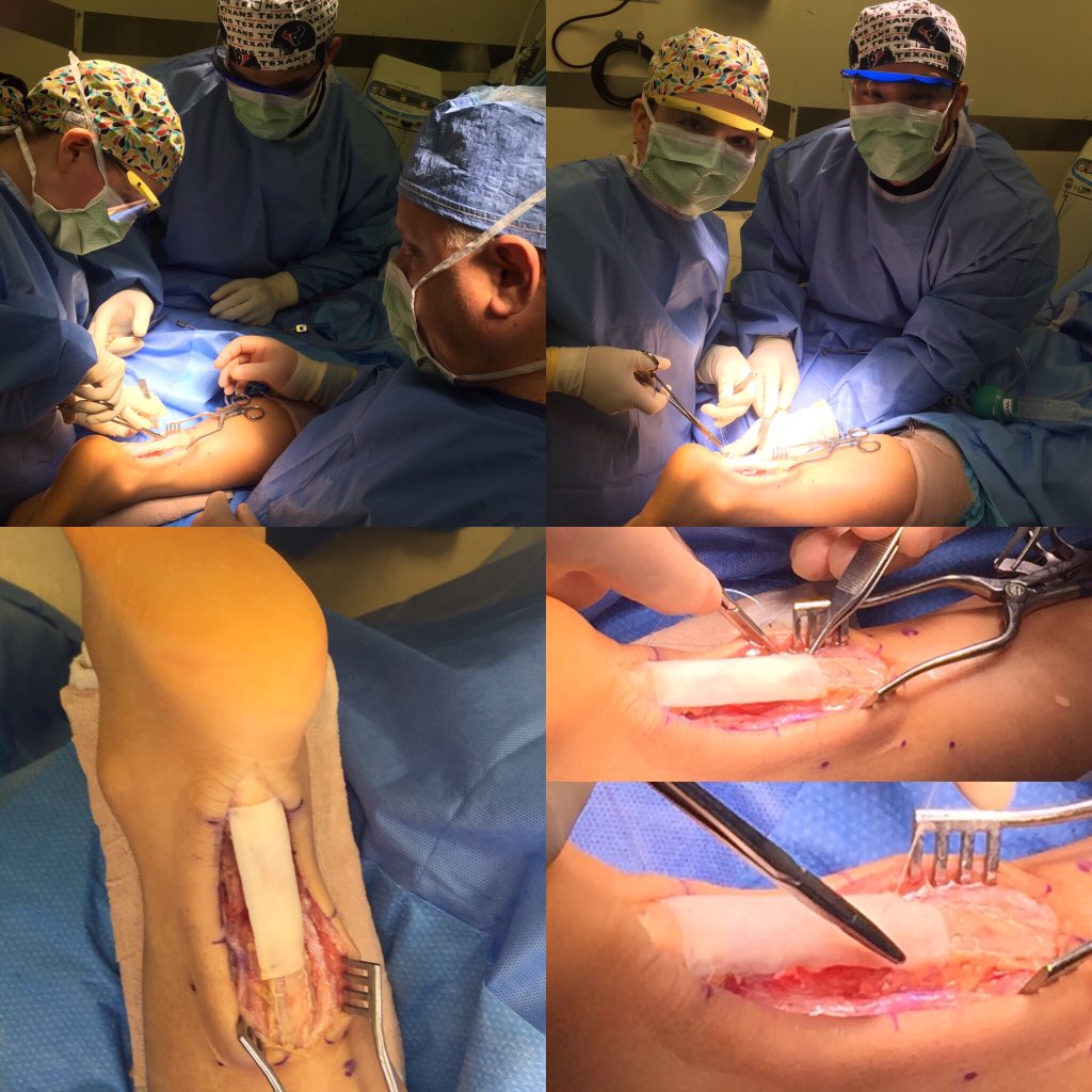 footanklefellow's tweet photo. Repaired an almost 3wk old Achilles rupture with a 3cm gap and reinforced it with an artelon graft. #fafsf #artelon https://t.co/wLAbPKRUTV
