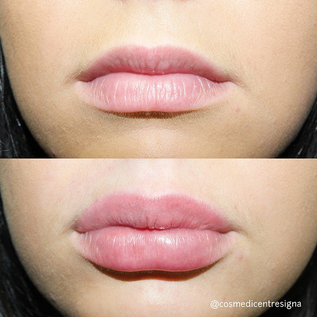 Cosmedicentre's tweet photo. Gorgeous lips, Before and after Lip Enhancements: https://t.co/7Dm7RkLGQD #Beauty #CosmeticInjectables #PerfLikeKurt https://t.co/1YZbwvEm76
