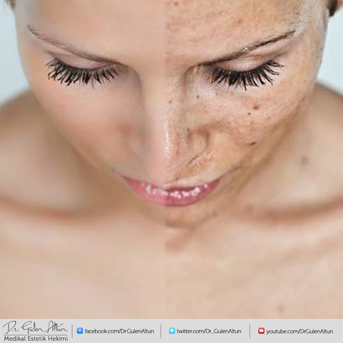 Cilt Lekesi Çeşitleri 
facebook.com/Dr.GulenAltun/…
#cilt #leke #melazma #güneş #hormon #tedavi #deri #solaryum #sağlık