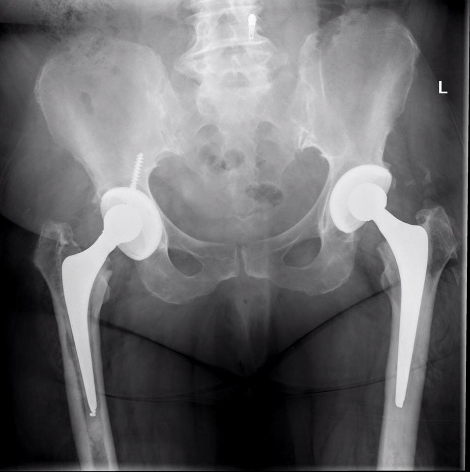 RadiologySigns's tweet photo. Q: Is there any abnormality of these hip prostheses? ANSWER: https://t.co/QknCI4QIsi #FOAMrad #FOAMed https://t.co/ph8SU7Njxk
